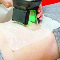 أشعة الليزر تدخل مجال إنقاص الوزن