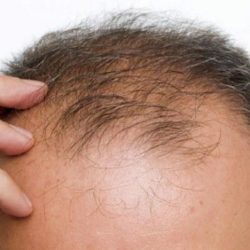 دواء محتمل لتحفيز إنتاج بصيلات شعر جديدة