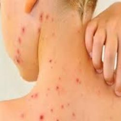 جدري القرود ينتشرفي الولايات المتحدة،و17 حالة مشتبه بها في مونتريال وعقار tecovirimat المناسب