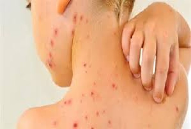جدري القرود ينتشرفي الولايات المتحدة،و17 حالة مشتبه بها في مونتريال وعقار tecovirimat المناسب